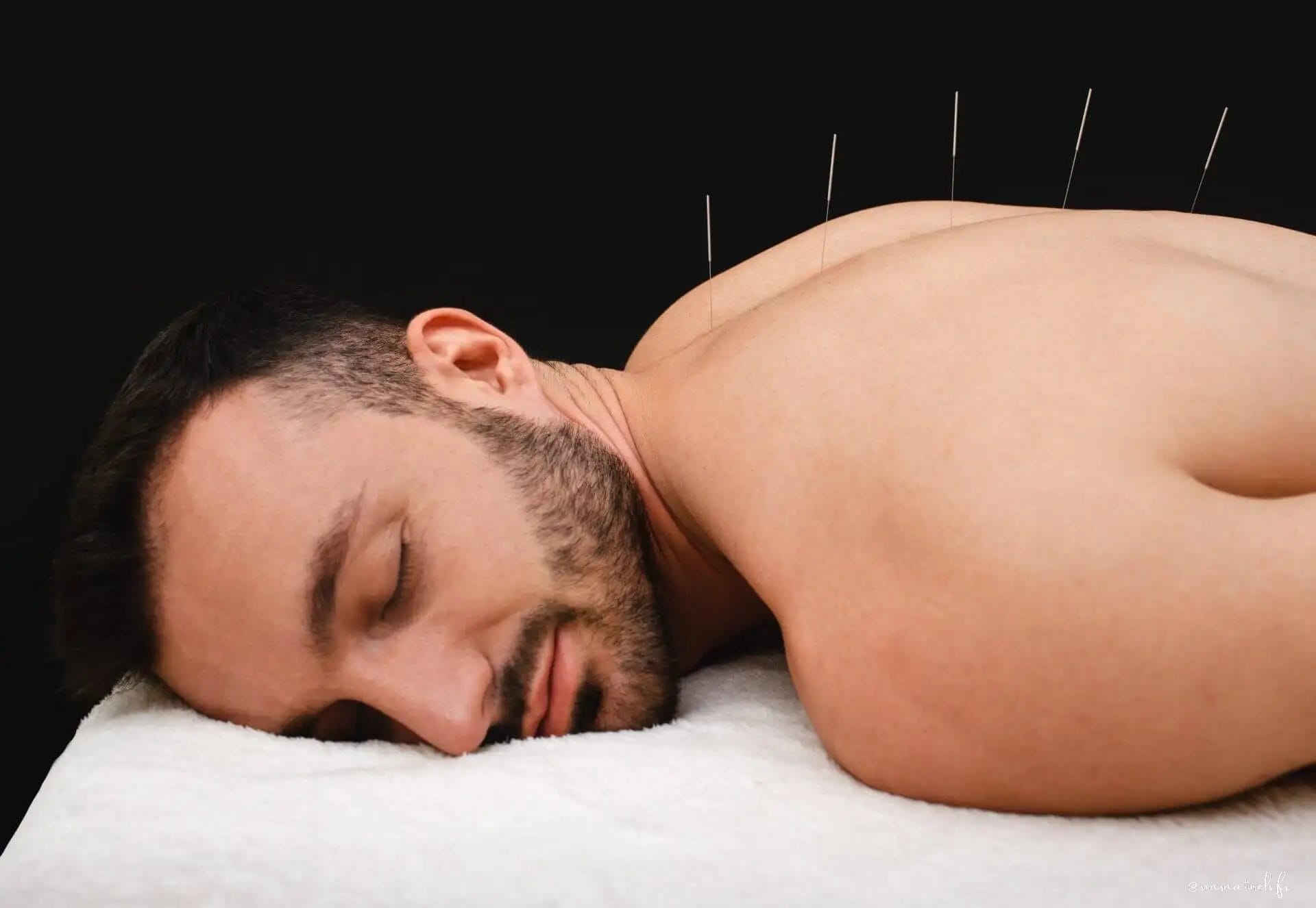 Les bienfaits de l'acupuncture sur la santé : guide complet