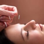 Les bienfaits du lifting énergétique et de l'acupuncture pour une guérison naturelle