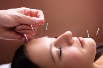 Les bienfaits du lifting énergétique et de l'acupuncture pour une guérison naturelle